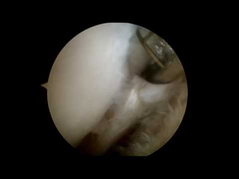 Segni di vertebrale toracica ernia Osteocondrosi della colonna cervicale e dolori articolari