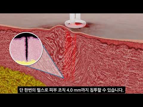 UltraPulse with SCAAR FX Product Video | Lumenis