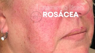 TRATAMIENTO DE LA ROSÁCEA CON LÁSER