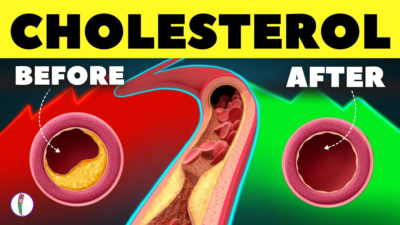 10 Natural Ways to Clear Your Artery | High Cholesterol | LDL | HDL | Heart Attack (prevention tips)