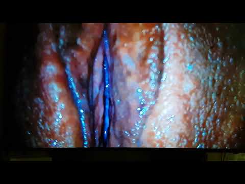 Masaje perineal
