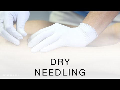 Dry Needling