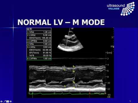 Assessing Left Ventricular Function