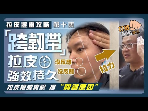 【拉皮避雷攻略|第十集】拉皮手術為何需要「跨韌帶」拉提「內側臉」? 筋膜拉皮效果維持太短暫嗎? 拉皮權威用實驗告訴你「關鍵原因」