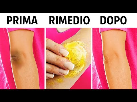Lentiggine di albergo di ospite Come un limone per candeggiare posti di pigmentary su una faccia