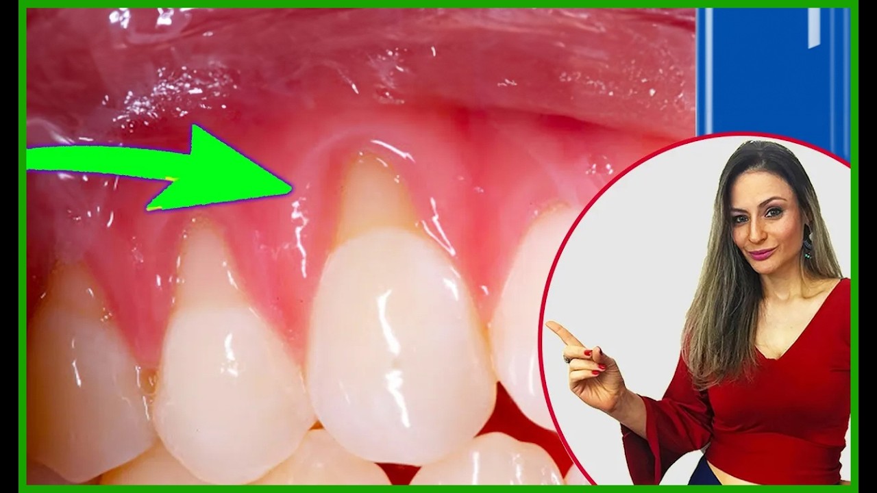Gingival Retraction how to end DEFINITIVE!! Home Recipe or Surgery?!
