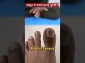 Nail Fungus Remove Permanently Shorts Nailfungus Desiilaj