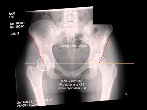Iniezioni per il trattamento delle articolazioni delle gambe Infiammazione delle articolazioni in SLE