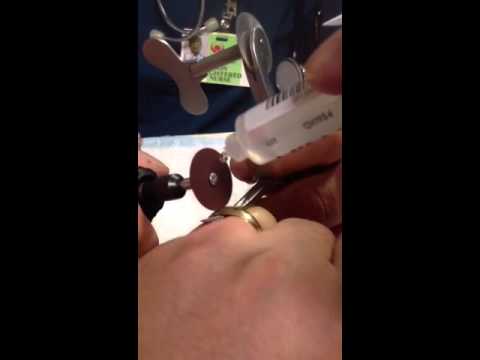 ER Ring Removal Video