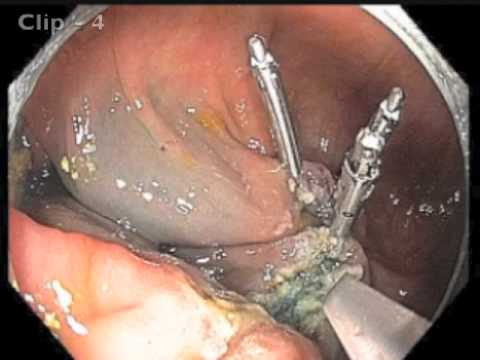 Flat Lesion in Ileocecal Valve - Clip closure