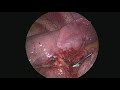 11-Minute VATS Right Lower Lobe Lobectomy (Nonedited)