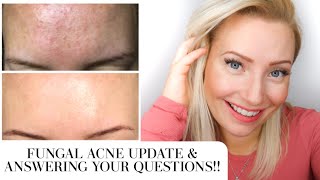 *2 MONTH UPDATE* GET RID OF TINY BUMPS ON FOREHEAD FAST | HOW TO TREAT FUNGAL ACNE (MALASSEZIA)