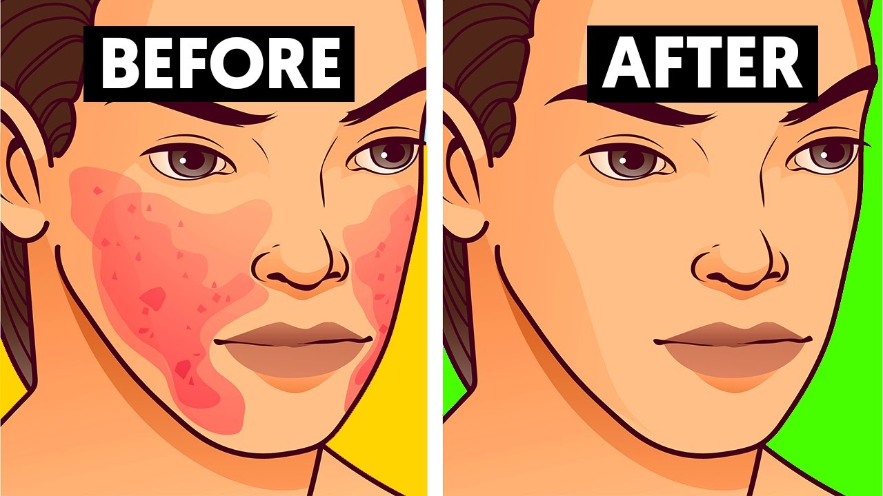 How To Get Rid of Your Acne Scars Fast