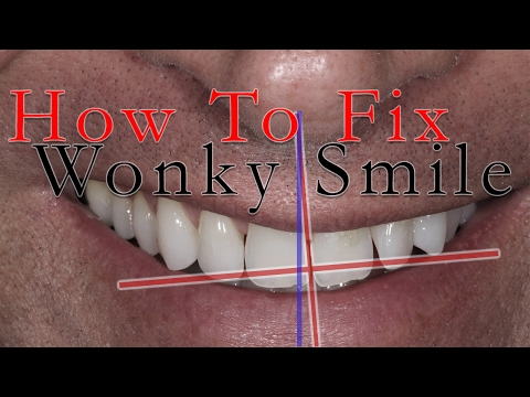 download lagu mp3 mp4 How To Fix Lopsided Smile, download lagu How To Fix Lopsided Smile gratis, unduh video klip How To Fix Lopsided Smile