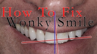 How to fix a Wonky Smile