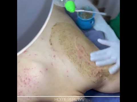 Back Acne Treatment in Poipet