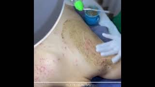 Back Acne Treatment