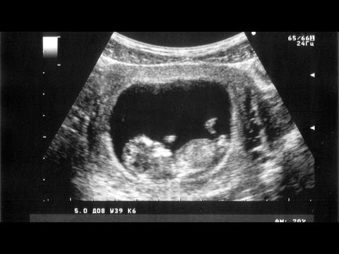 Click to Watch the 'Please God. Just take care of my son' - UC Davis performs 'miracle' surgery on unborn child STILL IN THE WOMB video