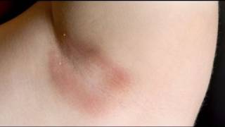 Comó evitar la irritación de la piel en los bebés