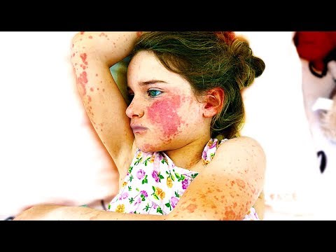 WE FOUND HER WITH MACULOPAPULAR RASH (SHOCKING)