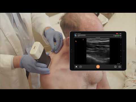 Suprascapular Nerve Block  - Ultrasound Scanning Technique