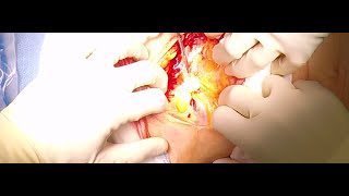 Cesarean Section; OBGYN Surgical Techniques with Dr. Kerry Campbell, MD