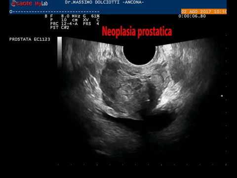 Ragazze massaggio della prostata Transrettale ecografia della prostata e delle vescicole seminali