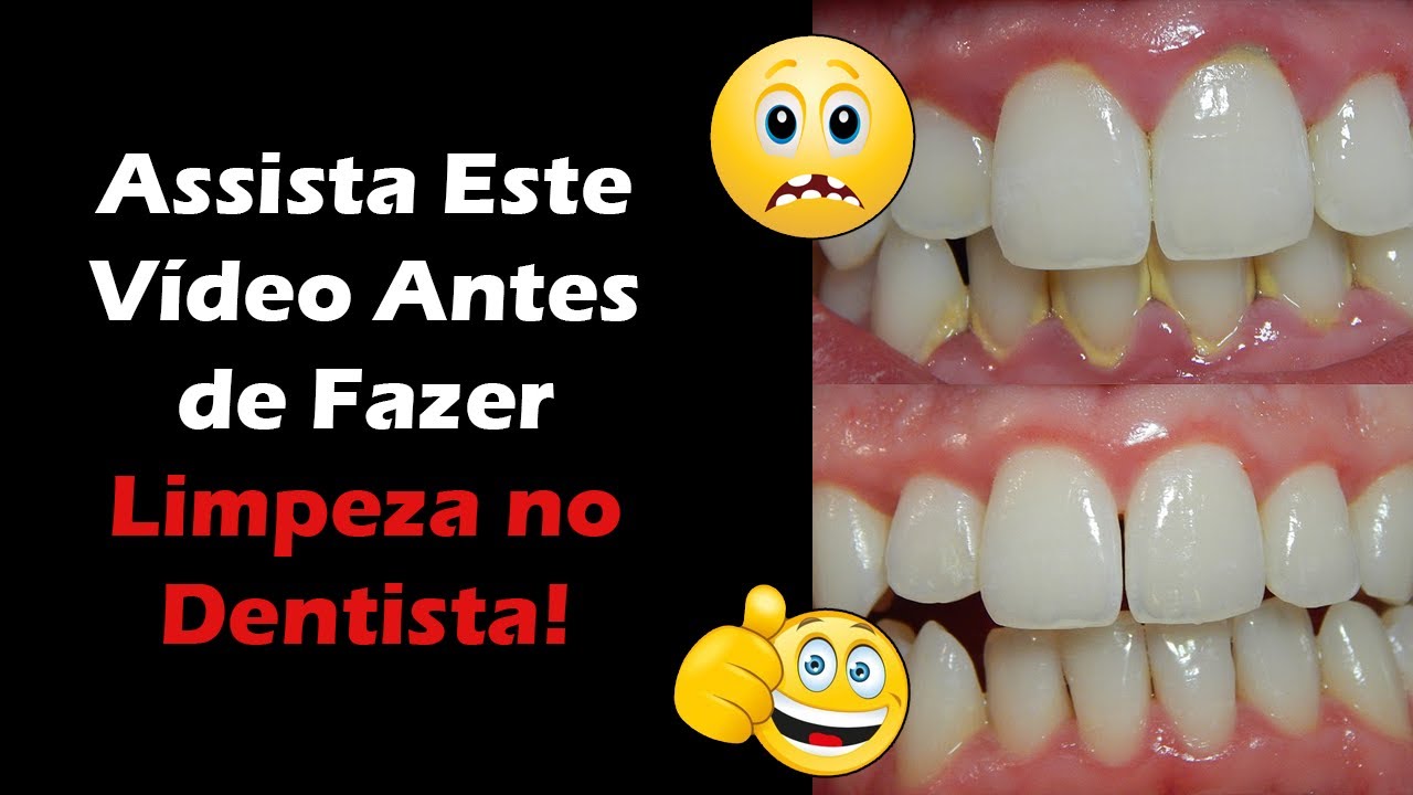Watch Now Limpeza nos Dentes Qual o Valor e Como é Feita - Dentista Responde Dúvidas Sobre Remoção de Tártaro Limpeza nos Dentes Qual o Valor e Como é Feita - Dentista Responde Dúvidas Sobre Remoção de Tártaro