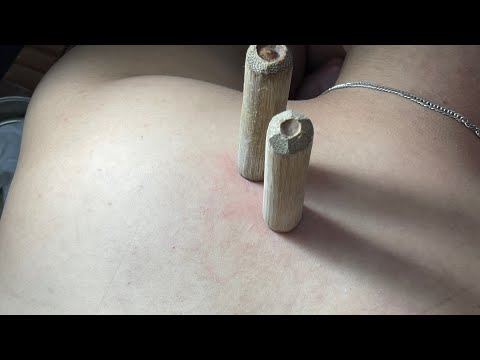 Acne clots on the back – Acne Treatments Mai Ngoc