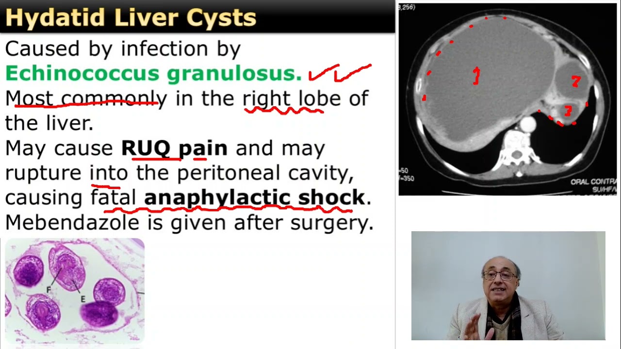 Hydatid Liver Disease
