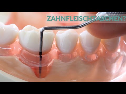 Parodontitis: Die wichtigsten Informationen zur Behandlung