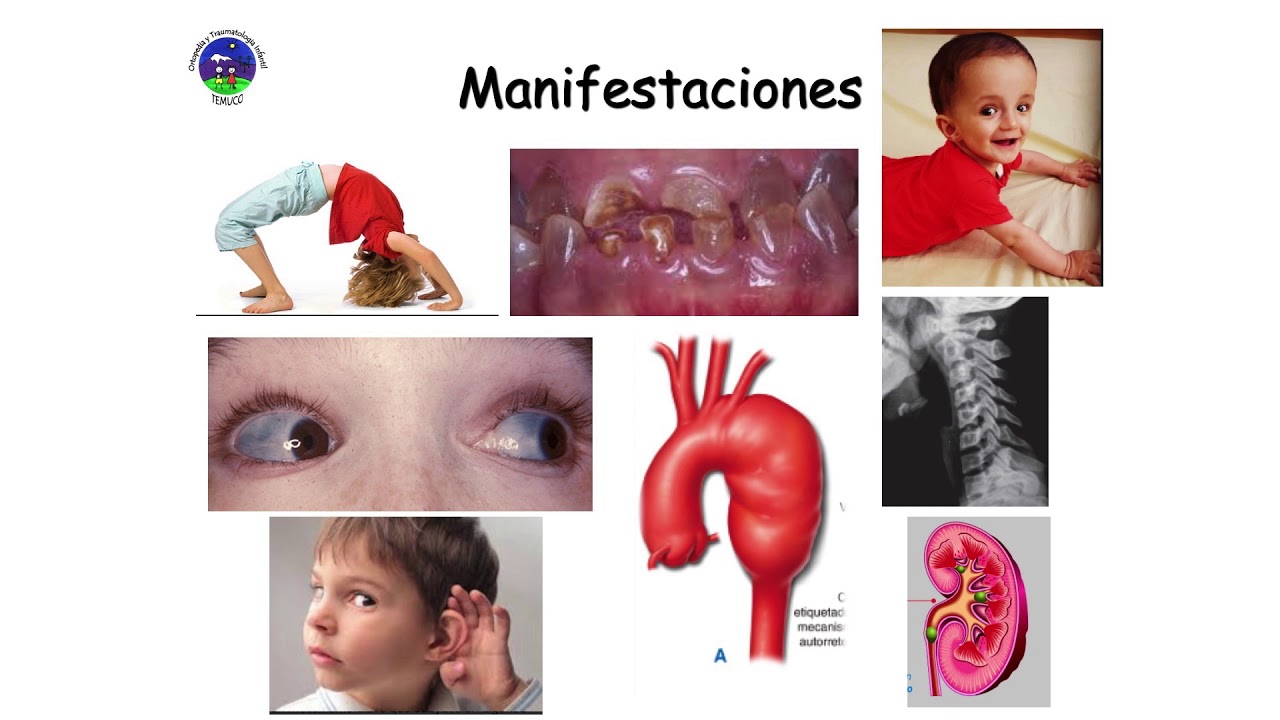 Condiciones Ortopedicas - 11 - Osteogénesis Imperfecta - Dra. Mónica Foppiano