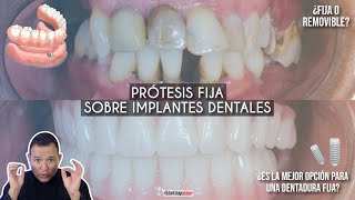 Prótesis fija sobre Implantes dentales, 🔩 La mejor opción para volver a sonreír 🤔 -Odontología Láser