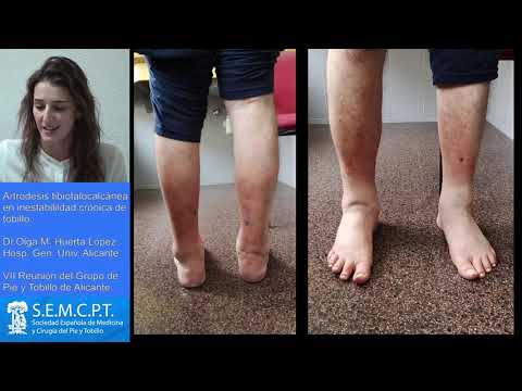 download lagu mp3 mp4 Caminar Con Artrodesis De Tobillo, download lagu Caminar Con Artrodesis De Tobillo gratis, unduh video klip Caminar Con Artrodesis De Tobillo