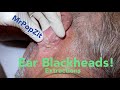 Ear Blackhead extractions. Multiple techniques used for deep embedded dry plugs and cyst pops.