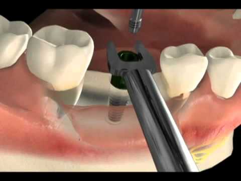 Cirurgia de implante dentário - Vídeo da técnica - São Paulo SP