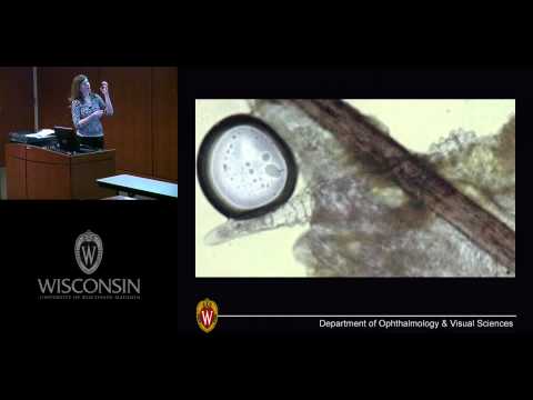 Ocular Rosacea: Curse of the Celts and Celebs