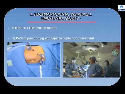 Laparoscopic Radical Nephrectomy