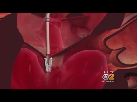 Tiny Heart Clip Can Repair Leaky Valves