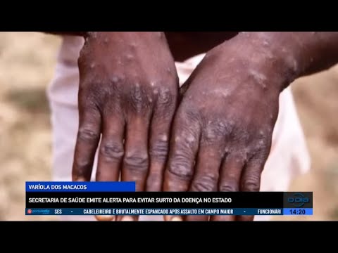 Secretaria de Saúde emite alerta para evitar surto de Varíola dos Macacos no Piauí 26 07 2022