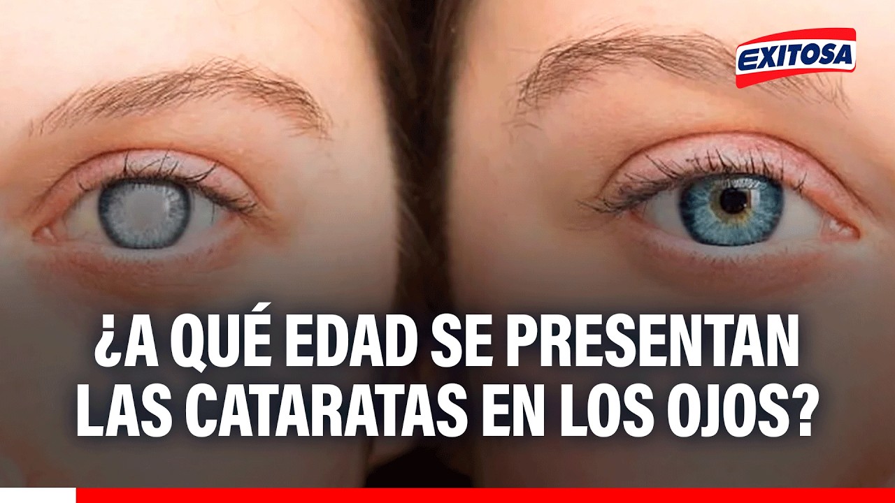 🔴🔵 ¿En qué edad se presentan las CATARATAS en los ojos?