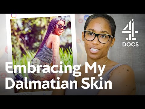 I’m Proud Of My Skin Condition And Will Show It Off To The World | My Body My Rules | Channel 4