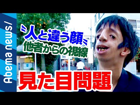 稀な病気を持つ俳優は、外見や反応にどう対処しているかを説明する。「私たちは友達になれるの?」