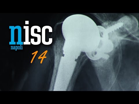 Epatite con sintomi di dolori articolari Nel mal di schiena