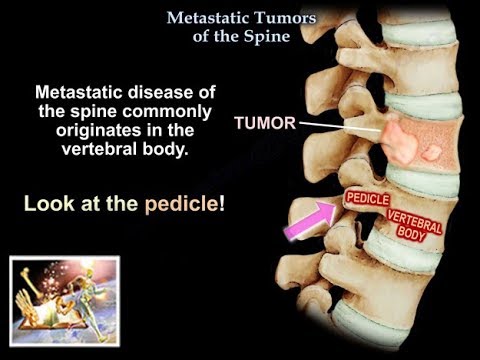 Metastatic Tumors Of The Spine  - Everything You Need To Know - Dr. Nabil Ebraheim
