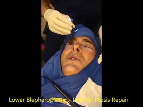 Cosmetic Lower Blepharoplasty on a Physician Cosmetic Lower Blepharoplasty on a Physician
