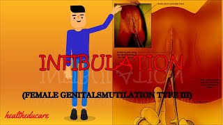 INFIBULATION (FEMALE GENITAL MUTILATION TYPE III)