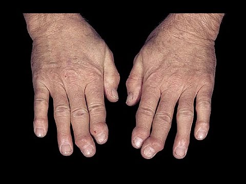Erholung nach Knie-Arthroskopie Zeit Dysplasien des Ellenbogengelenks