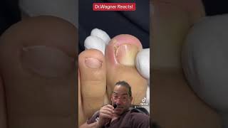 Download lagu DID THE INGROWN NAIL PERFORATE THE SKIN?😳#shorts mp3