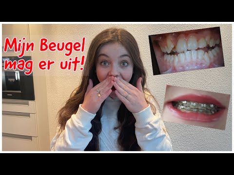 MY BRACES CAN FINALLY COME OFF!!! - Bibi